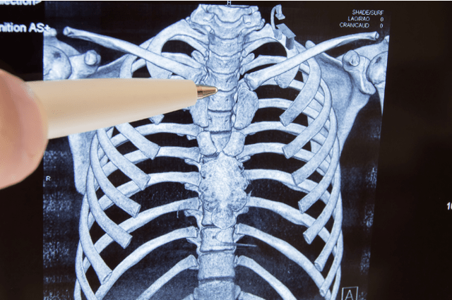Osteokondrosia
