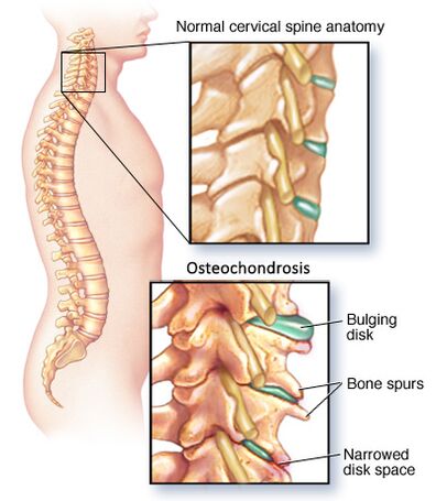 Osteokondosi zerbikala