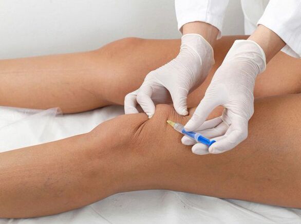 belauneko artrosirako artikulazio barneko injekzioa