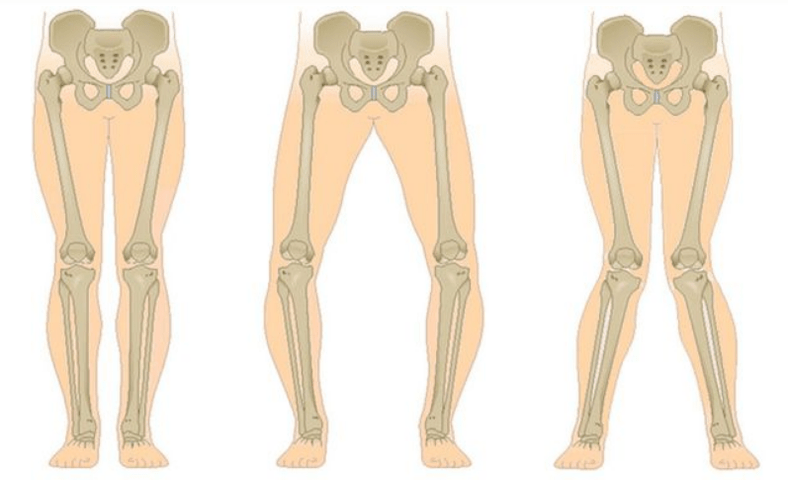 belauneko artrosiaren konplikazioak